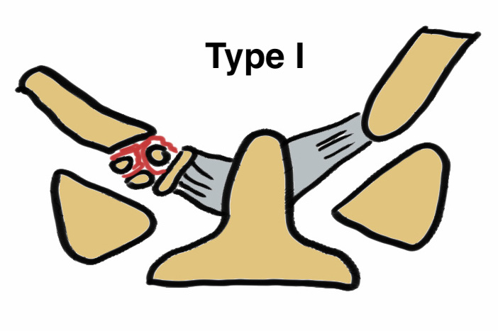 Occipital Condyle Fractures The Bone School 7013